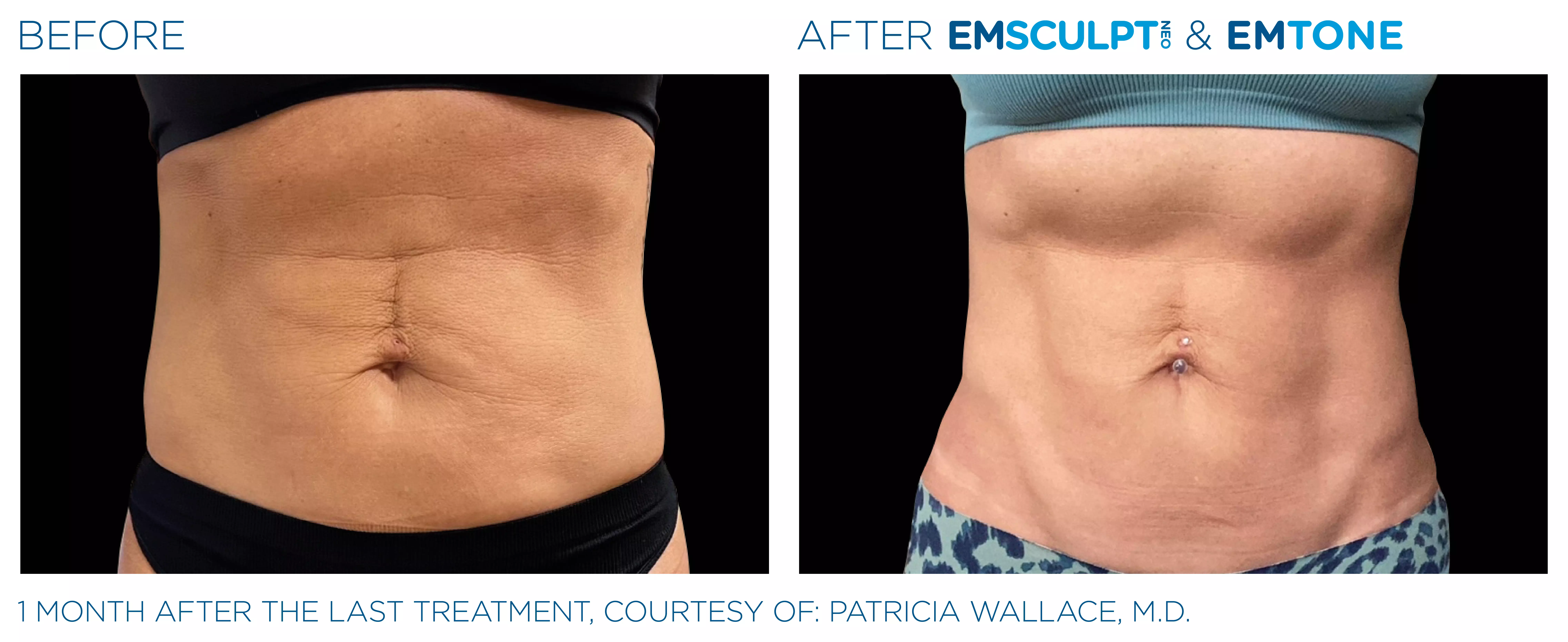 Emsculpt_Neo-Emtone_PIC_Ba-card-female-abdomen-001_ENUS100