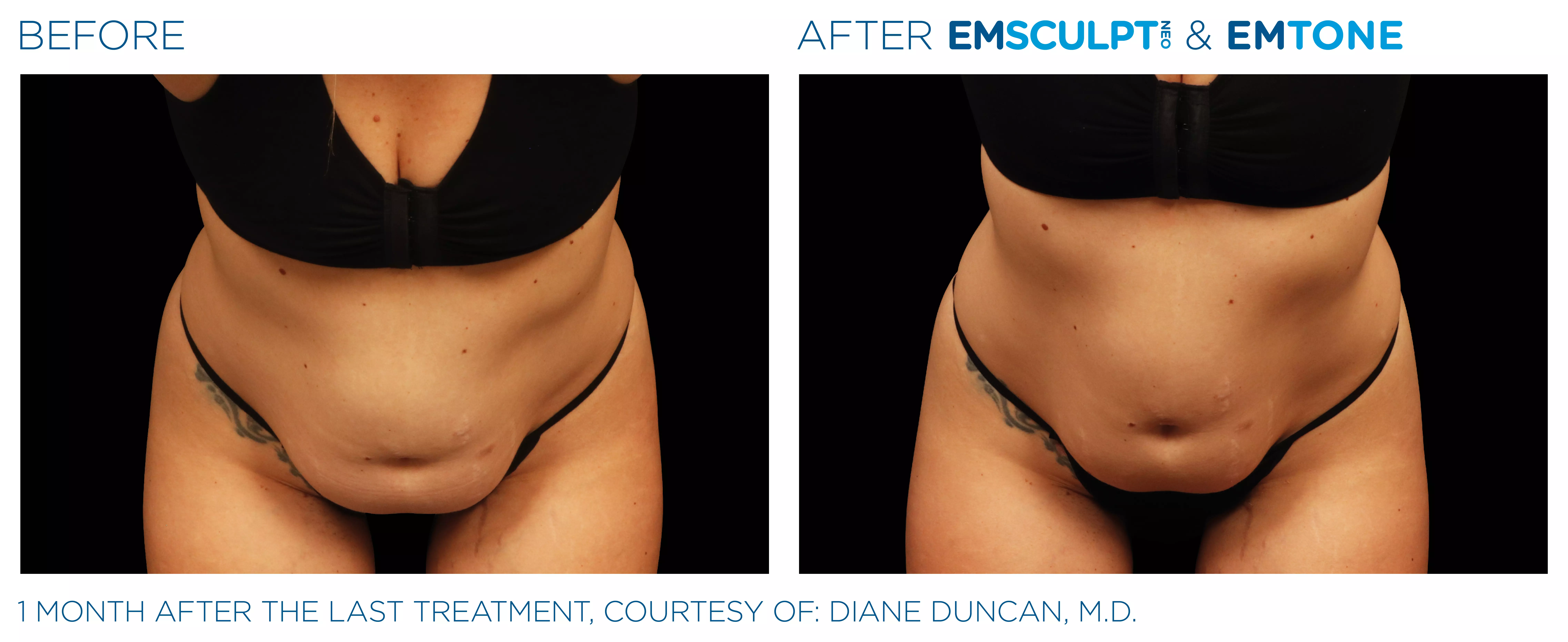 Emsculpt_Neo-Emtone_PIC_Ba-card-female-abdomen-003_ENUS100