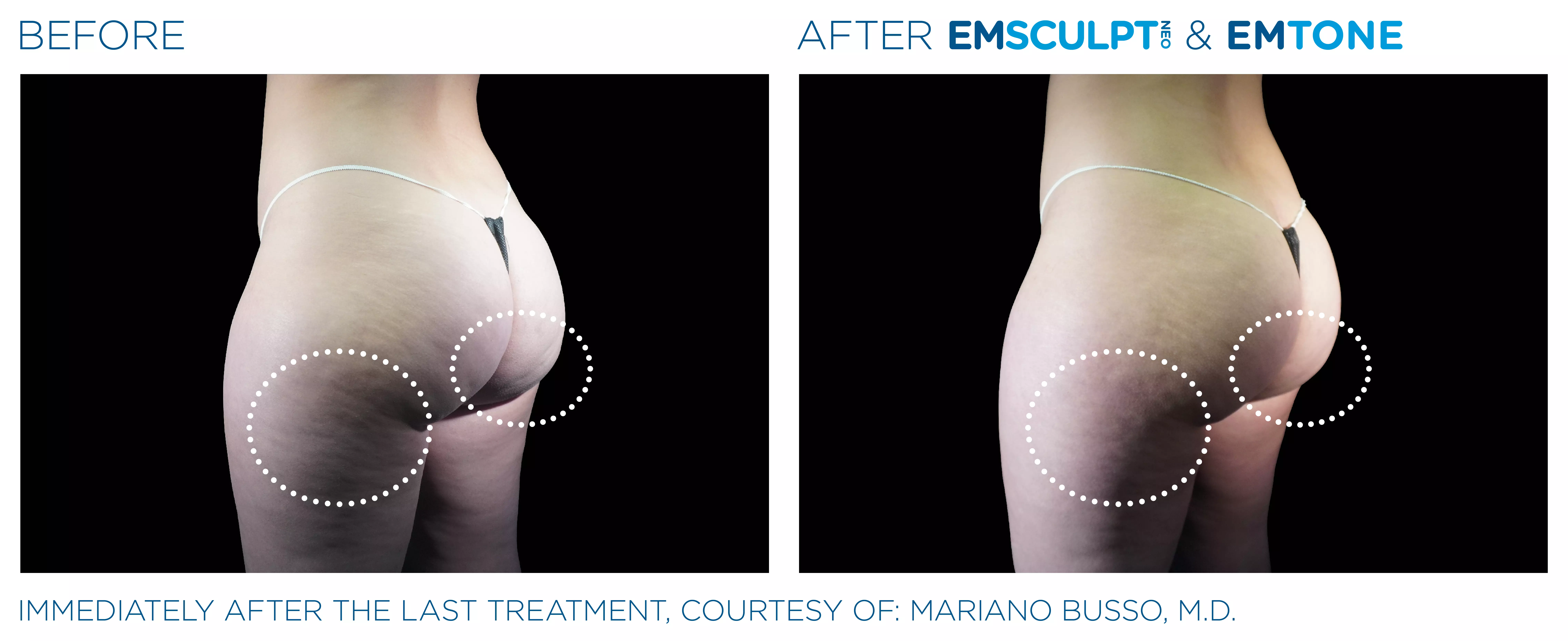 Emsculpt_Neo-Emtone_PIC_Ba-card-female-buttock-012_ENUS100