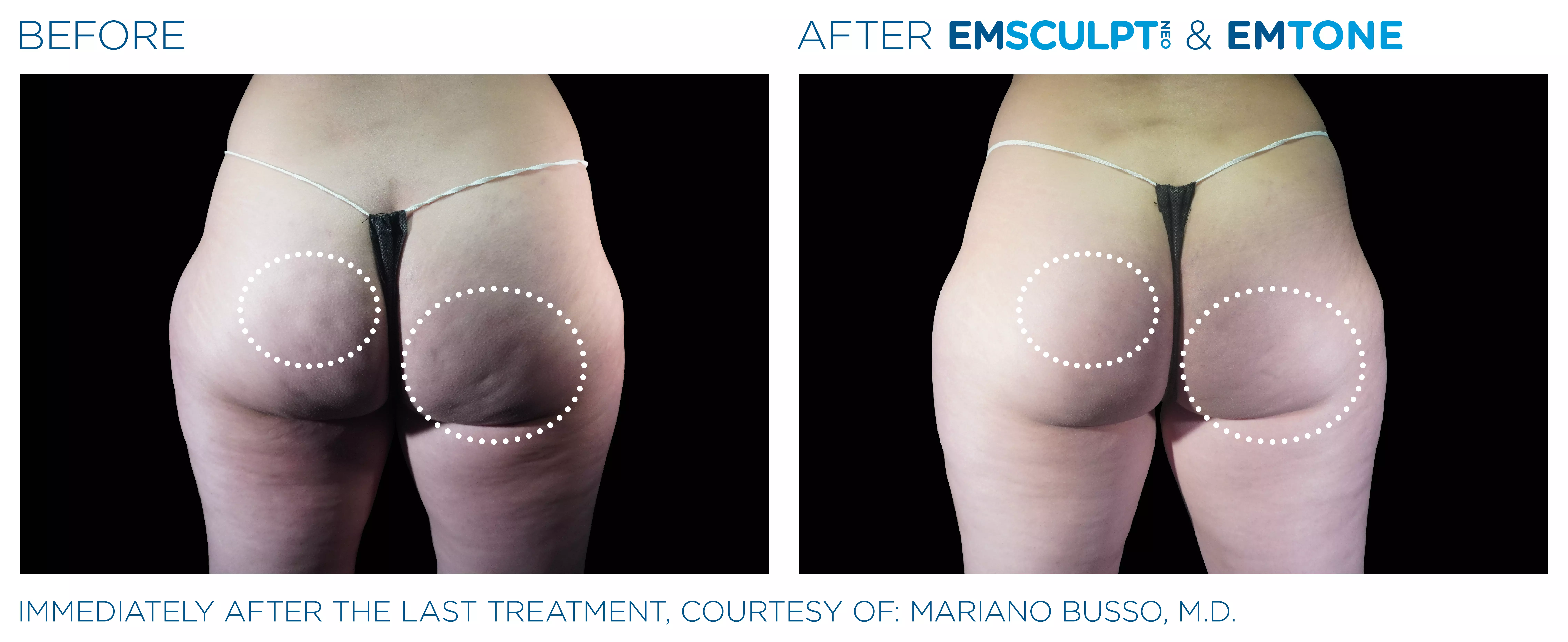 Emsculpt_Neo-Emtone_PIC_Ba-card-female-buttock-011_ENUS100