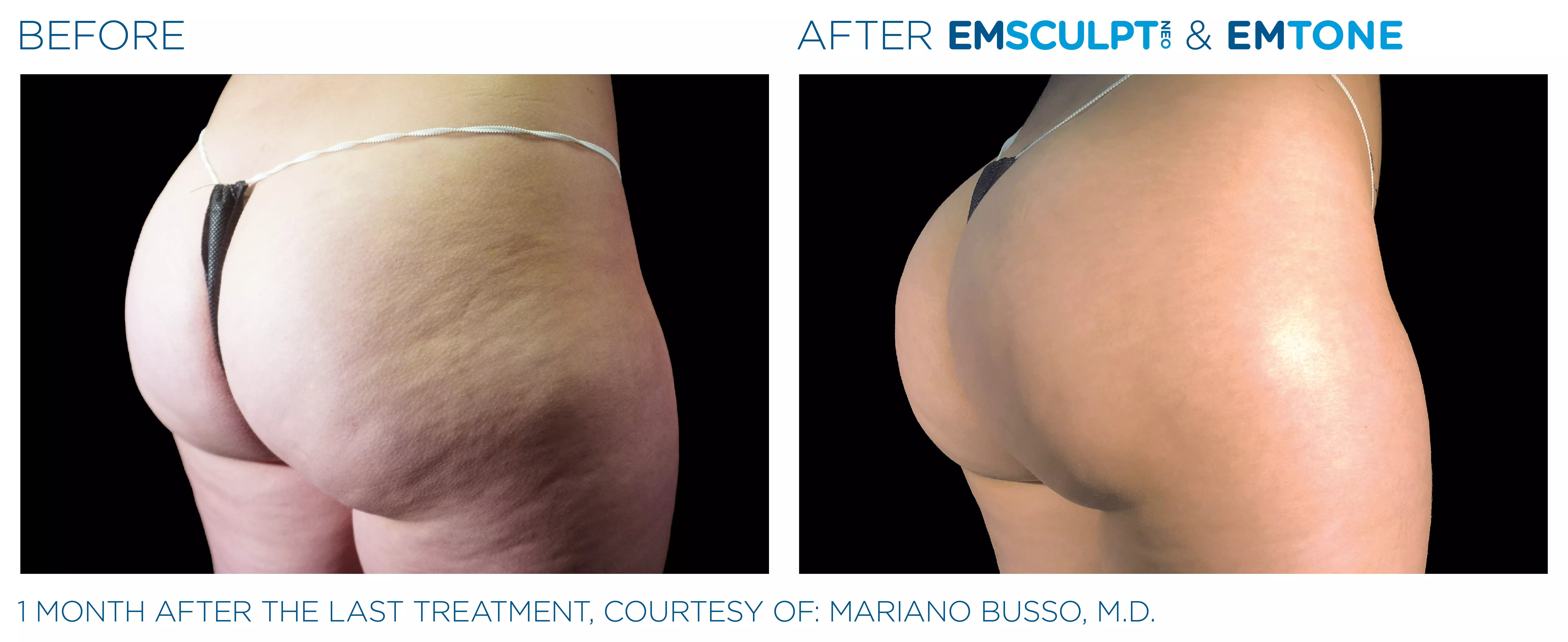 Emsculpt_Neo-Emtone_PIC_Ba-card-female-buttock-008_ENUS100