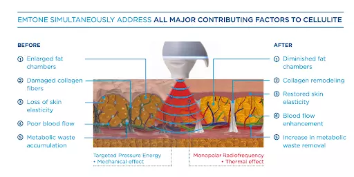 EmTone Simultaneously Address Infographic