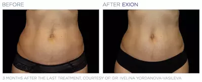  exion abs